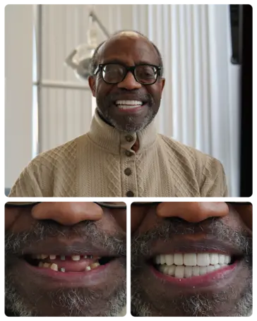 Full mouth Implants transformation — Shelem
